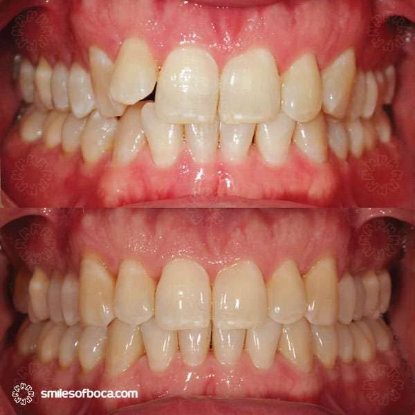 invisalign before and after retracted 030 2