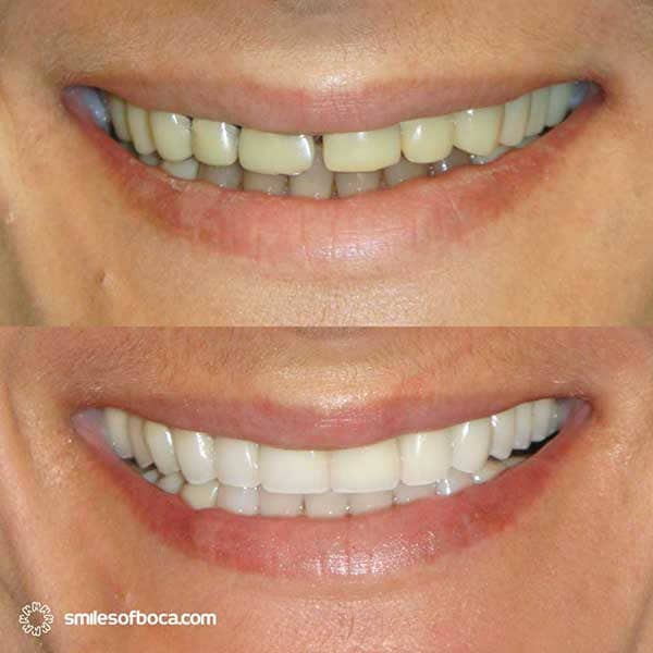 porcelain crowns full mouth before after 012 1