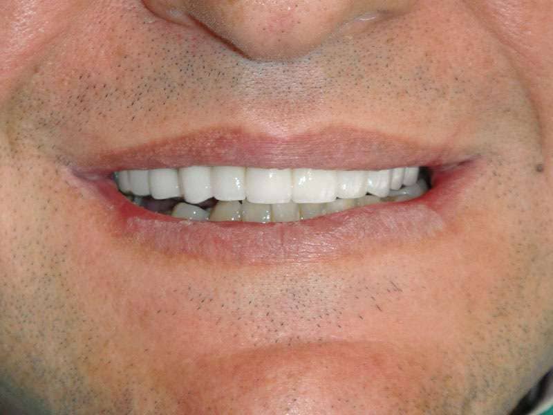 case 023 porcelain crowns after 1