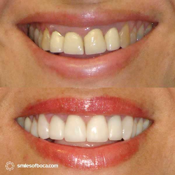 Porcelain Crowns - Case 004 porcelain crowns before after 004 1