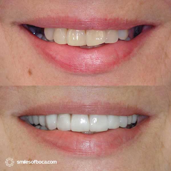 porcelain-crowns-implants-before-after-016-1 invisalign before and after