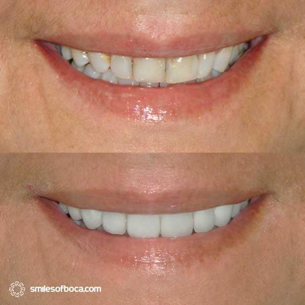 Porcelain Veneers - Case 007 porcelain veneers before after 007 1