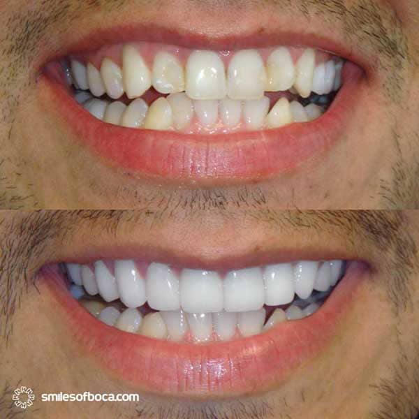 Porcelain Veneers - Case 009 porcelain veneers before after 009 1