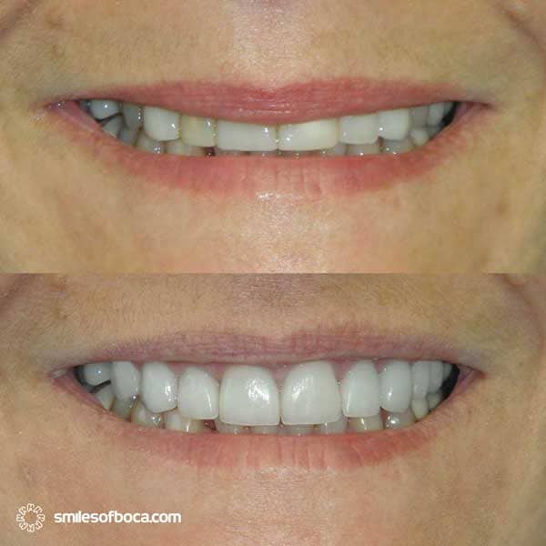 porcelain-veneers-before-after-011-1 invisalign before and after