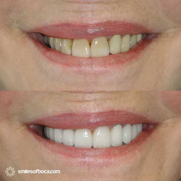 porcelain-veneers-before-after-020-1 porcelain veneers before after 020 1