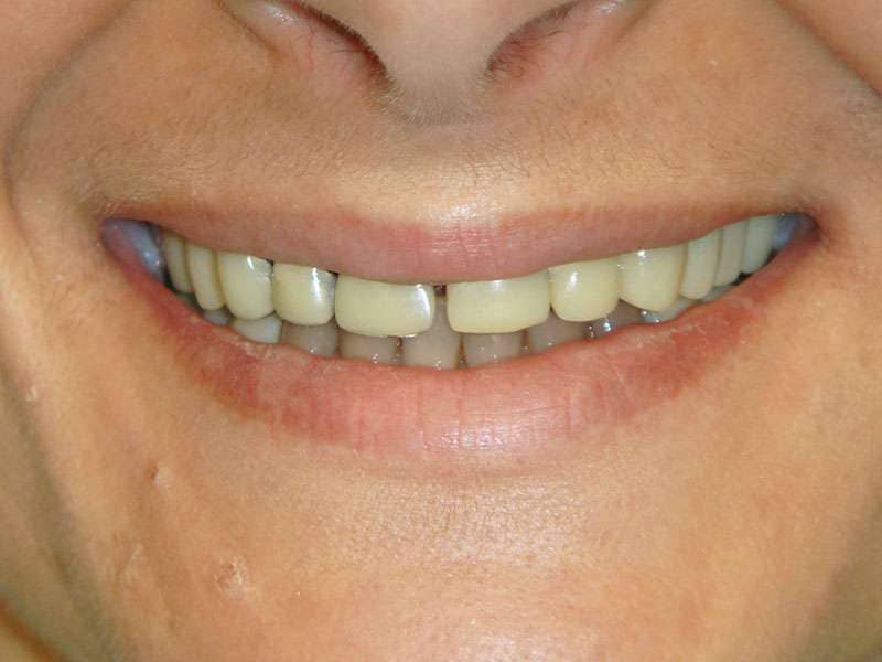 case 012 full mouth reconstruction Before 1 case 012 full mouth reconstruction Before 1