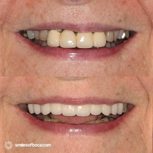 case-134-porcelain-bridge-before-after-smile case 134 porcelain bridge before after smile
